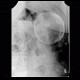 Cyst of a spleen, splenic cyst, calcified: X-ray - Plain radiograph